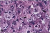Fig. 9.27 Epithelioid malignant peripheral nerve sheath tumour. A Some tumours B Extensive SIOO positivity. C Marked nuclear immunoreactivity for SOX 10. include rhabdoid cells with eosinophilic paranuclear globular to fibrillar inclusions (arrows). 