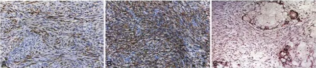 Fig. 9.25 Malignant peripheral nerve sheath tumour (MPNST). immunoreactive to chromogranin. A Patchy Sloo expression. B E6FR Immunoreactivity. C Glandular MPNST, containing neuroendocrine cells 