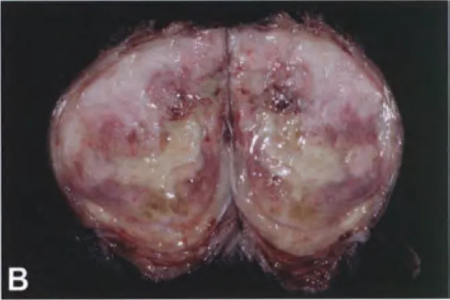 Fig. 9.23 Malignant peripheral nerve sheath tumour (MPNST). A Resected MPNST with its parent nerve on the left. Note the skeletal muscle that forms part of the surgical margin, indicating invasion into the surrounding soft tissues. B On cut sufface, this tumour shows the classic variegated appearance, with fleshy soft cellular regions alternating with yellow foci of necrosis. 