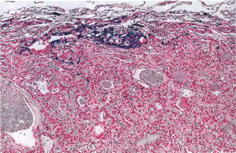 Machine generated alternative text: Fig. 6.56 This paraganglioma shows subcapsular haemosiderin, visualized with Peris Prussian blue stain. 