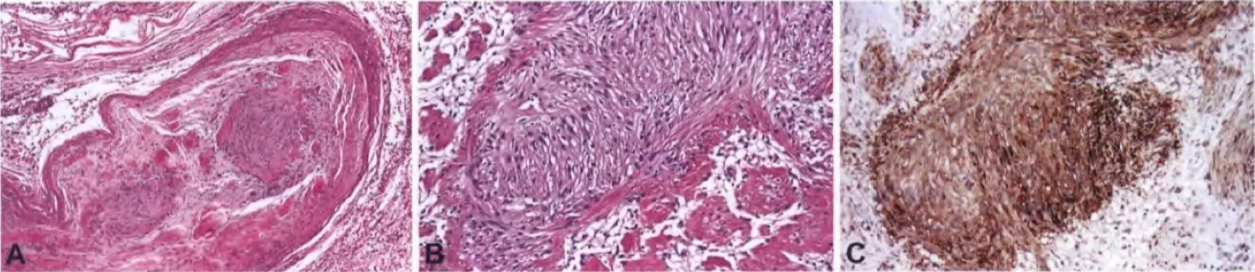 Fig. 9.20 Hybrid schwannoma/perineurioma. A Benign spindle cell nerve sheath tumour with loose myxoid stroma that is difficult to classify on H&E alone. B SIOO immunostaining highlights about tN0 thirds of the hybrid nerve sheath tumour cells, identifying the Schwann cell component. C EMA staining highlights about one third of the tumour cells, identifying the perineurial component. Fig. 9.21 Hybrid neurofibroma/schwannoma. Schwann cell micronodules. C S100-positive Schwann cell micronodules. 