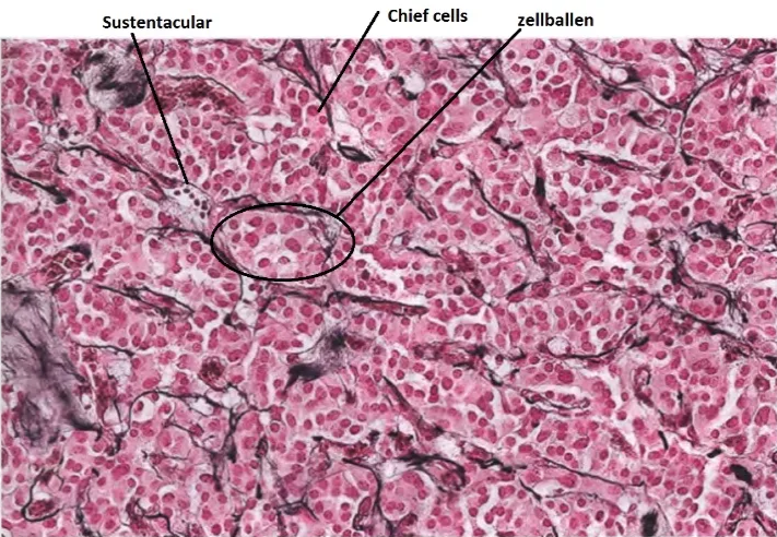 Sustentacular Chief cells zellballen Fig. 6.55 Paraganglioma. Reticulin silver staining highlights typical Zellballen architecture. 