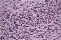 Fig. 9.26 Malignant peripheral nerve sheath tumours with divergent differentiation. A Rhabdomyoblastic differentiation (malignant triton tumour). B Formation of glands. C Focal myogenic differentiation visualized by desmin-positive tumour cells. 