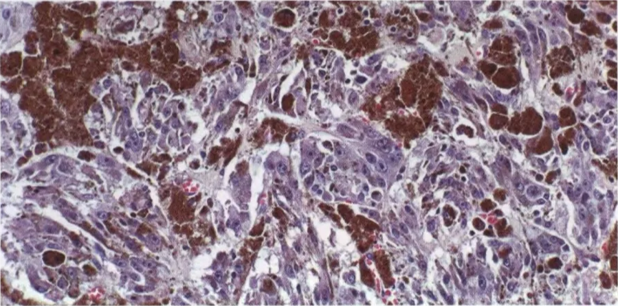 Fig. 9.10 Melanotic schwannoma with clusters of plump, spindled, and epithelioid, heavily pigmented tumour cells. 