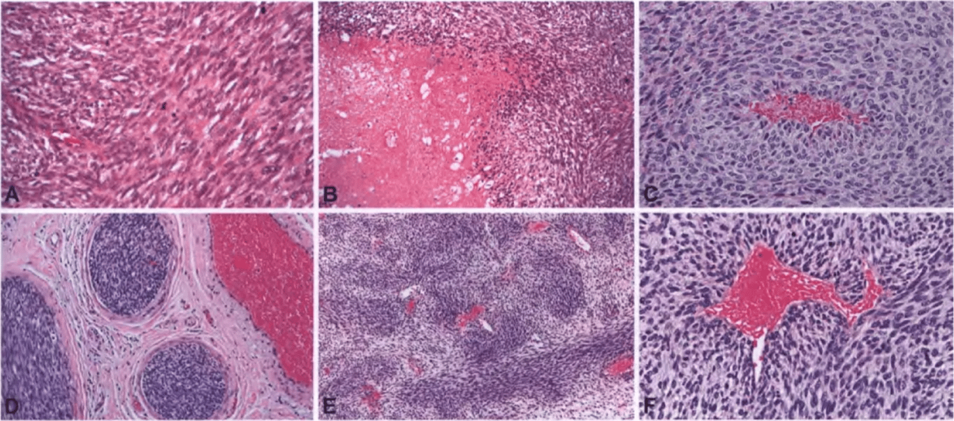 Fig. 9.24 Malignant peripheral nerve sheath tumour (MPNST). A Brisk mitotic activity. B Weil-delineated geographical necrosis. C A pattern of perivascular hypercellularity and slight intraluminal herniation. D Intraneural spread of tumour into small neural fascicles. E Marbled, alternating light (loose) and dark (compact) appearance is typical of some MPNSTs. F Intralum inal vascular herniation of tumour cells is seen in this tumour. 