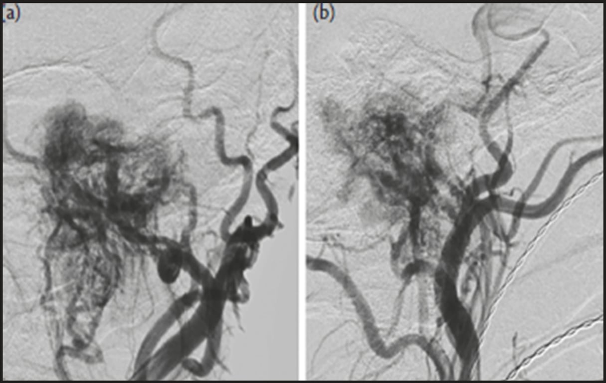 A close-up of an angiogram AI-generated content may be incorrect.