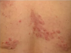 _e,4é.. Shagreen patch in tuberous sclerosis Shagreen patch in tuberous sclerosis Shagreen patch in tuberous sclerosis 