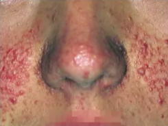 Angiofibromas in tuberous sclerosis Angiofibromas in tuberous sclerosis Angiofibromas in tuberous sclerosis 