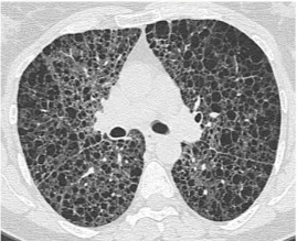 A close-up of a lung AI-generated content may be incorrect.