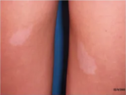 Ash leaf marks in tuberous sclerosis Ash leaf marks in tuberous sclerosis Ash leaf marks in tuberous sclerosis 