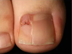 Periungual fibroma in tuberous sclerosis Periungual fibroma in tuberous sclerosis Periungual fibroma in tuberous sclerosis 