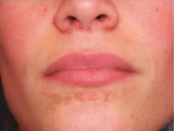 Angiofibromas in tuberous sclerosis Angiofibromas in tuberous sclerosis Angiofibromas in tuberous sclerosis 