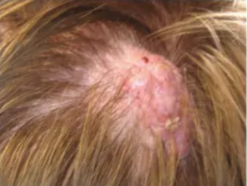 _e,4é.. Shagreen patch in tuberous sclerosis Shagreen patch in tuberous sclerosis Shagreen patch in tuberous sclerosis 