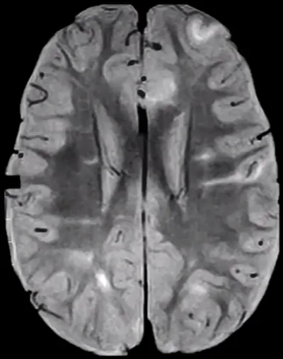 WM Abnormalities Straight or curvilinear bands Along lines of neuronal migration HETEROTOPIC NEURONAL AND GLIAL ELEMENTS 