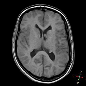 A close-up of a brain scan AI-generated content may be incorrect.