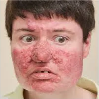 Figure 1 from Ablation of facial adenoma sebaceum using the ...