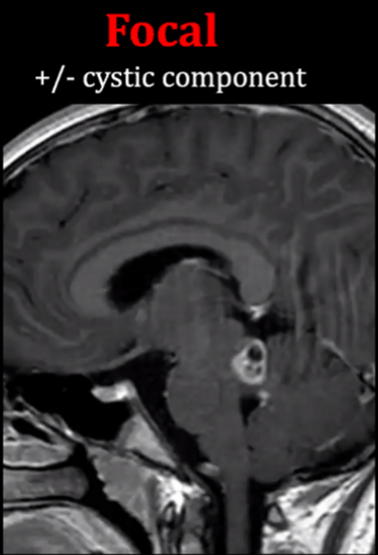 Focal (contrast-enhancing) pilocytic lesions