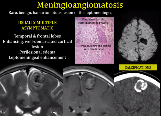 Meningioangiomatosis Rare, benign, hamartomatous lesion of the leptomeninges USUALLY MULTIPLE ASYMPTOMATIC Temporal & frontal lobes Fibroblast-like cells su rrounding blÖOd•ges Enhancing, well-demarcated cortical MicrovascUlatUre and lesion cé!ls prpliferauon Perilesional edema Leptomeningeal enhancement CALCIFICATIONS 