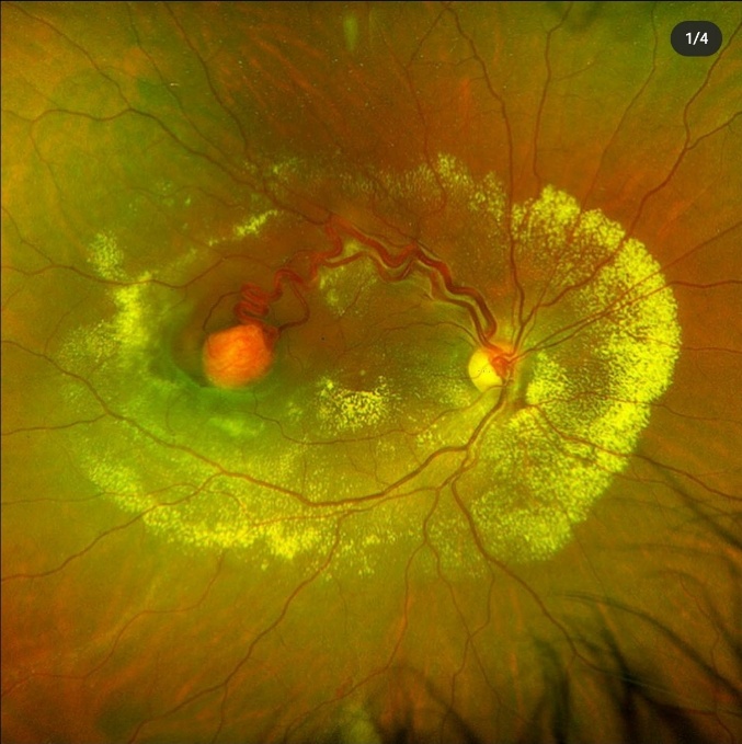 Retinal haemangioblastoma