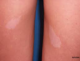 Tuberous sclerosis | DermNet NZ