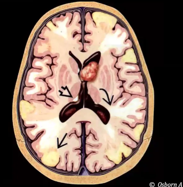 Brain lesions in TSC Developmental disorder of cell proliferation, migration, and differentiation CORTICAL TUBERS SUBEPENDYMAL NODULES WM ABNORMALITIES SEGA Not all these lesions are necessarily present in each patient O Osborn A 