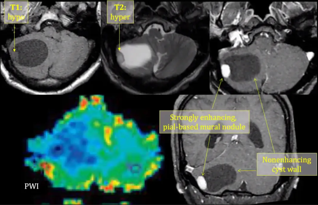 Cerebellar Hemangioblastoma gly enhancing Non PWI 