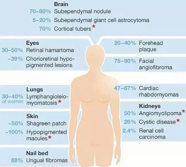 Pin by nonas arc on Tuberous Sclerosis | Tuberous sclerosis ...