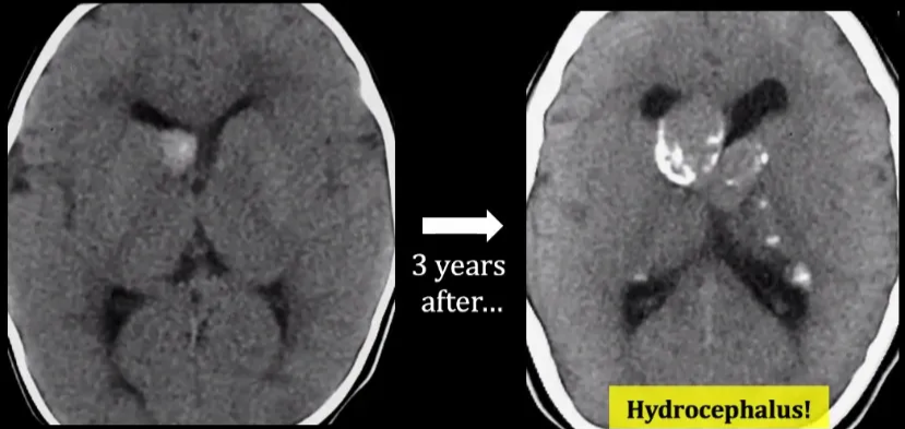 Sub-Ependymal Giant Cell Astrocytoma benign neoplasm (WHO grade 1) 2-26% of cases ofTSC Size > 10 mm FORAMEN OF MONRO, sometimes bilateral 3 years after... Hydrocephalus! 
