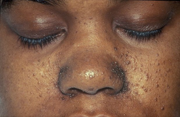 Tuberous sclerosis - Wikipedia