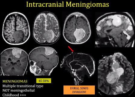 Multiple transitional type NOT meningothelial Childhood +++ DURAL SINUS INVASION! 