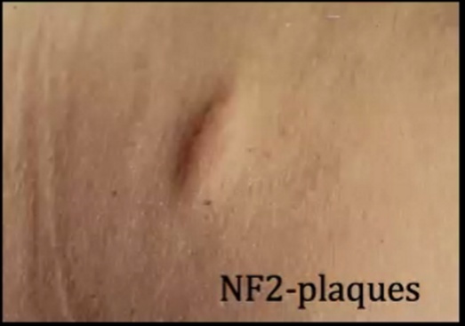 NF2-plaques 