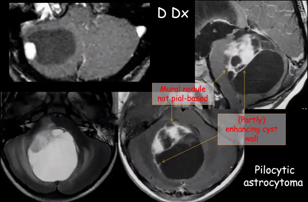 Cerebellar Hemanqioblastoma le not pial-b enhancing cyst Pilocytic astrocytoma 