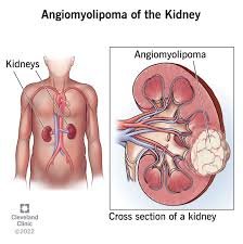 Angiomyolipoma Kidney: Causes, Symptoms ...