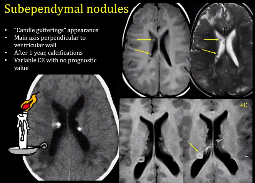 Subependymal nodules "Candle gutterings" appearance Main axis perpendicular to ventricular wall After I year, calcifications Variable CE with no prognostic value 