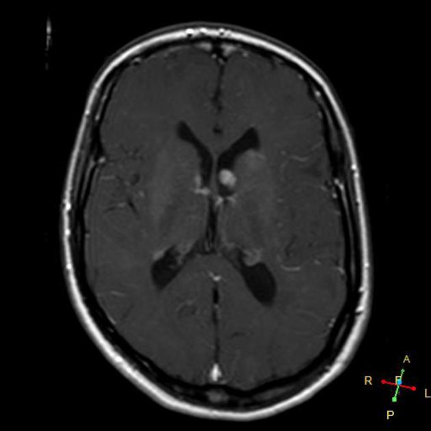 A close-up of a brain scan AI-generated content may be incorrect.