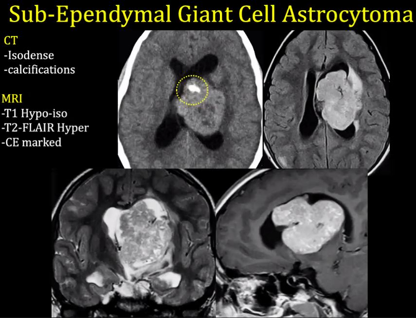 Sub-Ependymal Giant Cell Astrocytoma CT -Isodense -calcifications MRI -Tl Hypo-iso -T2-FLAIR Hyper -CE marked 