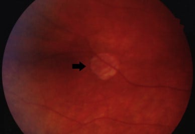 Retinal achromic patch indicated by arrow. | Download Scientific Diagram