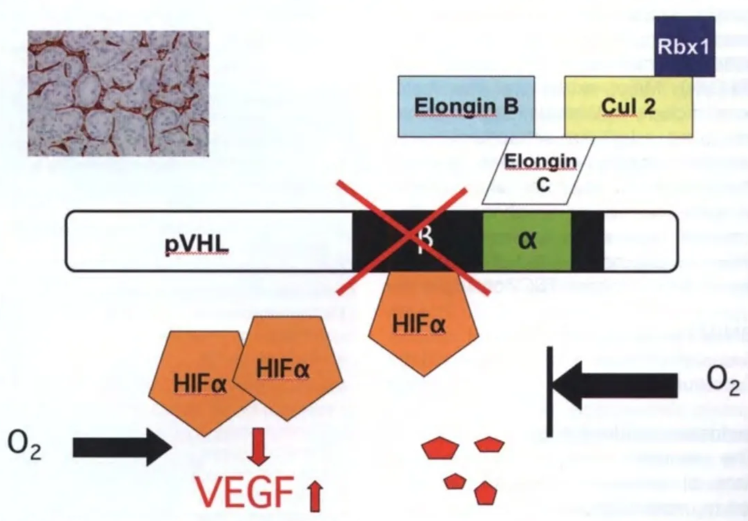 Elongin B c HIF« HIFO( HlFa Rbxl 02 02 VEGF t Fig. 16.18 VHL is a classic tumour suppressor gene. The VHL gene product (pVHL) has many different functions. The beta domain foms a complex with elongin and other proteins that regulate the function of hypoxia-inducible factors, including hypoxia-inducible factor protein (HIF) and VEGF. Under normoxic conditions, HIF degrades. Under hypoxic conditions, HIF accumulates. If pVHL is inactivated, there is no degradation of HIF, leading to an accumulation of VEGF, which explains why tumours associated with von Hippel-Lindau disease are highly vascularized. 