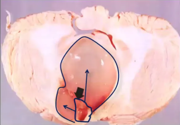 Hemangioblastoma Highly vascular nodule that abuts the pial surface Diffusion from vascular elements within the nodule accounts for cyst fluid The cyst wall is composed of compressed brain or reactive neuroglial cells, and is not considered part of the neoplasm 