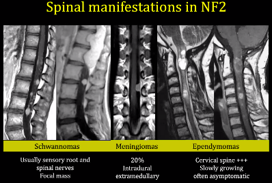 Spinal manifestations in NF2 Schwannomas Usually sensory root and spinal nerves Focal mass Meningiomas 20% Intra dural extramedullary Ependymomas Cervical spine +++ Slowly growing often asymptomatic 