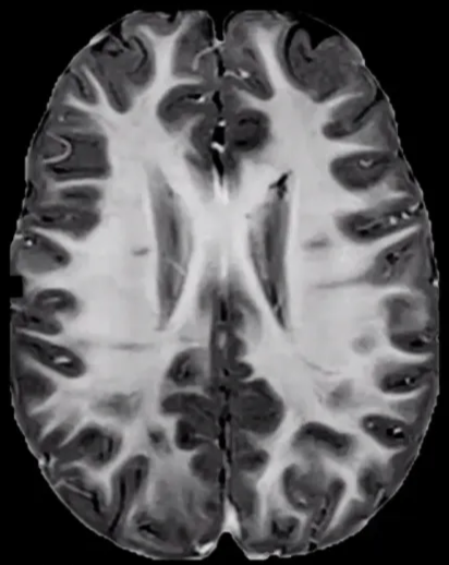 WM Abnormalities Straight or curvilinear bands Along lines of neuronal migration HETEROTOPIC NEURONAL AND GLIAL ELEMENTS 