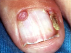 Periungual fibroma in tuberous sclerosis Periungual fibroma in tuberous sclerosis Periungual fibroma in tuberous sclerosis 