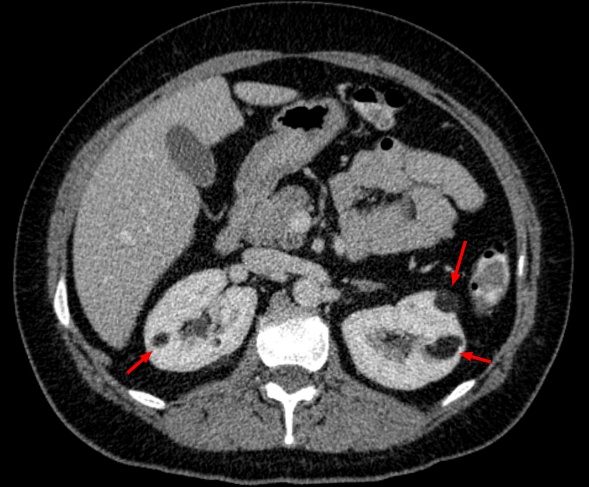 Angiomyolipoma - Wikipedia