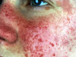 Angiofibromas in tuberous sclerosis Angiofibromas in tuberous sclerosis Angiofibromas in tuberous sclerosis 