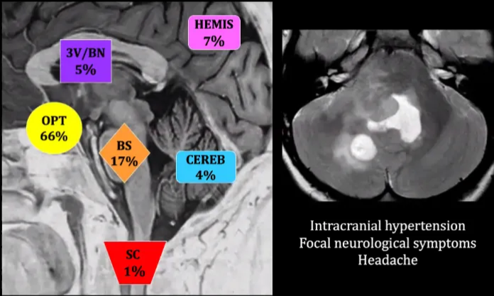 Other CNS tumors in NF1