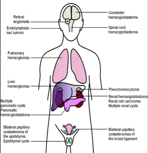 5 Von Hippel-Lindau disease rare, AD disorder 20% familiar benign and malignant tumors (about 40 different lesions in 14 different organs) Tumor suppression gene chromosome 3p25-26 2nd-3rd decades of life Rethal ErOIymghatc hem a r -VAS u ult* Pancreatic &labral papillary Of epa%lymis Epi$:lymal cysts Raul cel arcimrna Bihral Of 1. more than one CNS hemangioblastoma 2. one CNS hemangioblastoma and VHL visceral manifestations 3. any manifestation and a known family history of VHL disease 
