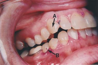 Which dental findings are characteristic of tuberous sclerosis ...