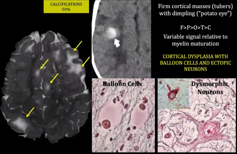 Cerebral Cortical Tubers CALCIFICATIONS 50% Ball 6n.Cens Firm cortical masses (tubers) with dimpling ("potato eye") Variable signal relative to myelin maturation CORTICAL DYSPLASIA WITH BALLOON CELLS AND ECI'OPIC NEURONS N eon 