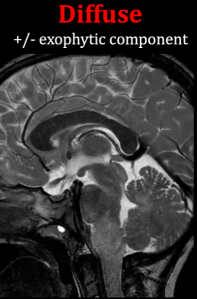 Diffuse (non contrast enhancing)