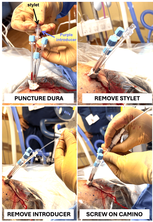 Figure 4. Screwing on Camino.